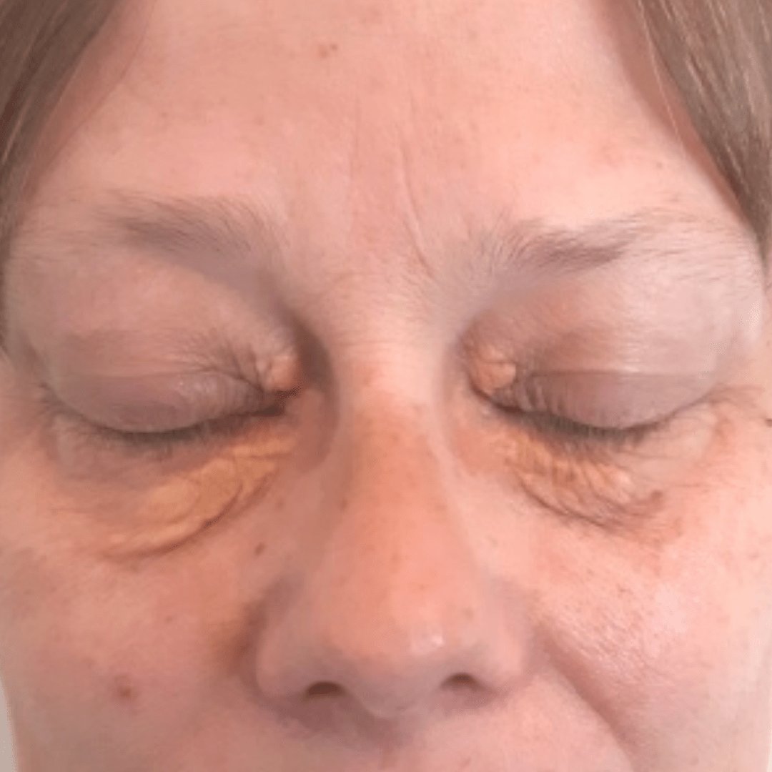 Før behandling af xanthelasma - Hudlæge Alba Privathospital