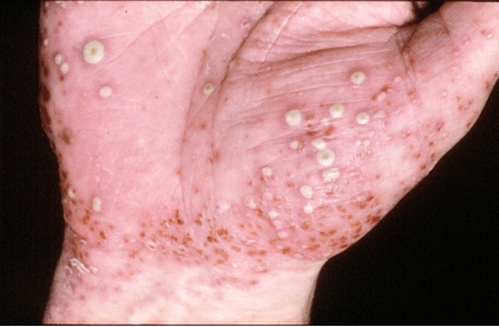 Psoriasis