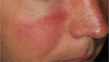 Behandling af rosacea