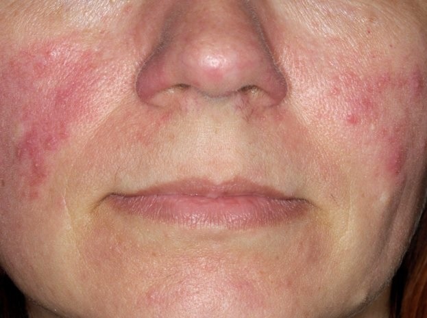 Rosacea rødme i ansigt - Hudlæge Alba Privathospital