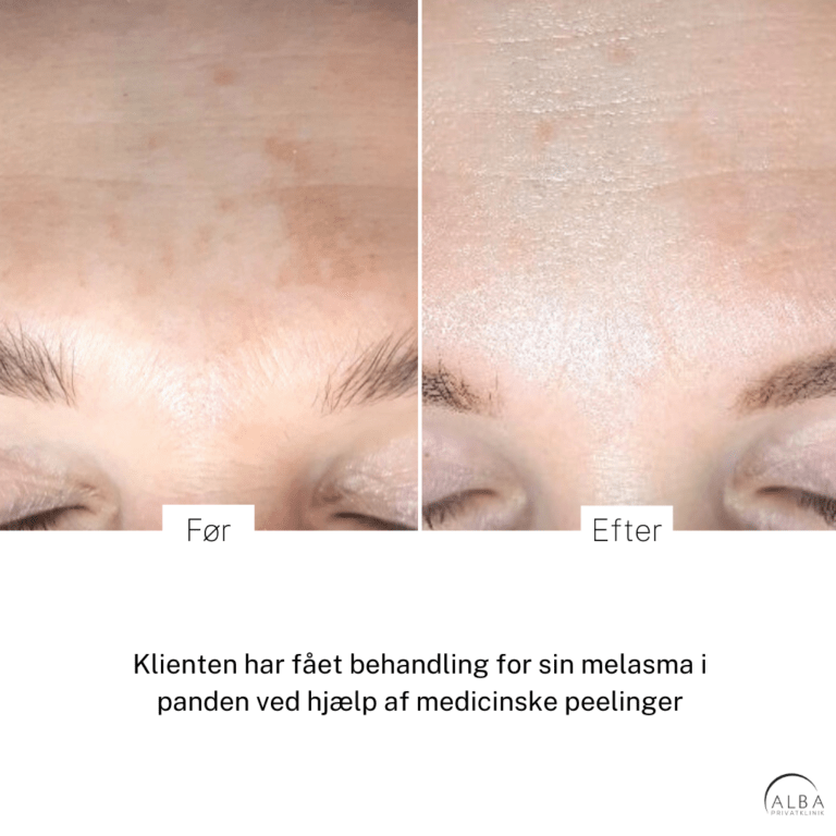 Melasma | 100% effektiv behandling | Alba Privathospital