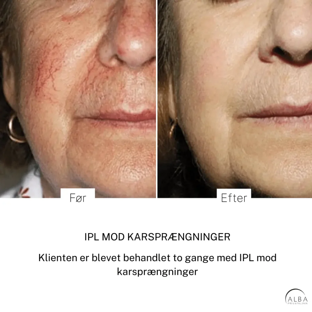 Hvad er rosacea (voksen akne)