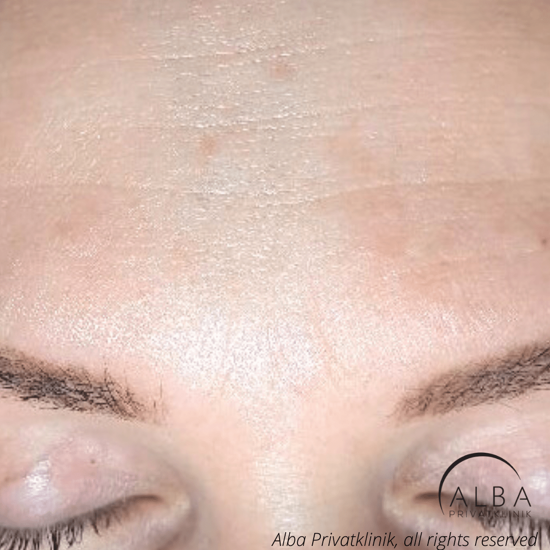 Melasma | 100 % effektiv behandling | Hudlæge Alba Privathospital