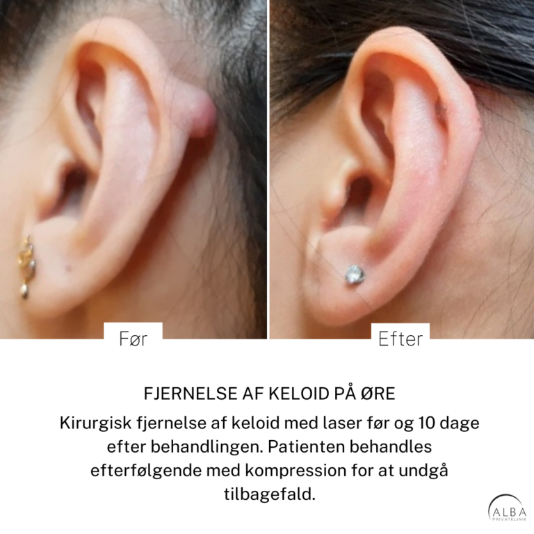 Før efter fjernelse af keloid på øre - Alba Privathospital