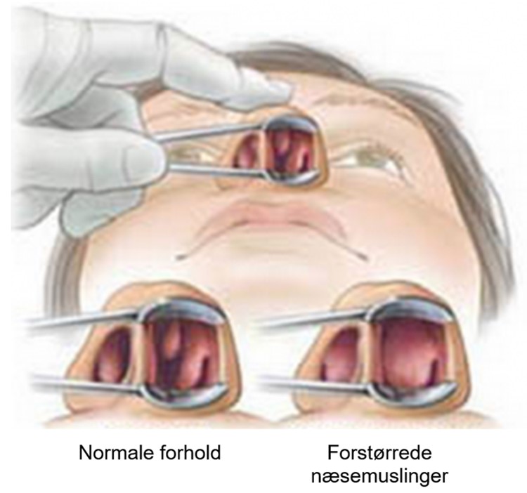 Forstørrede næsemuslinger kan give vanskelig vejrtrækning gennem næse. Det korrigeres nemt ved en operation hos vores speciallæger på ALBA privathospital