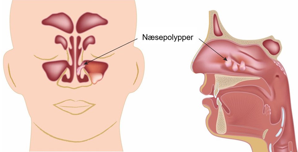 Næsepolypper | Øre næse halslæge | Alba Privathospital