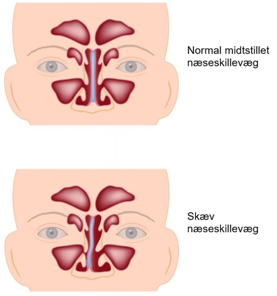 Operation for skæv næseskillevæg